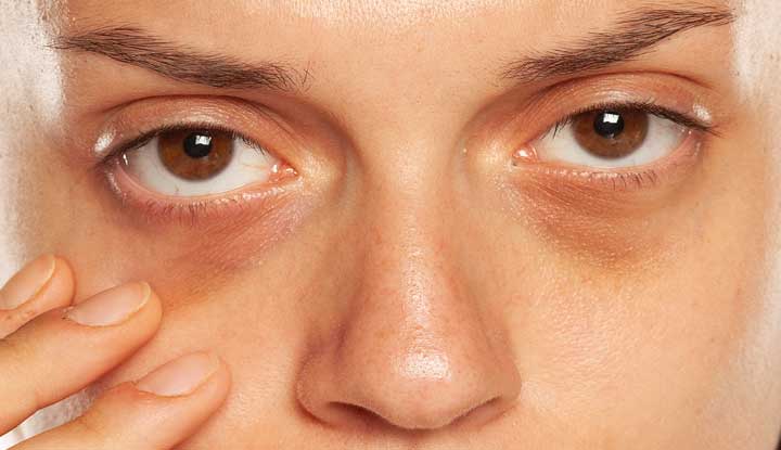 Natural remedies for under-eye puffiness