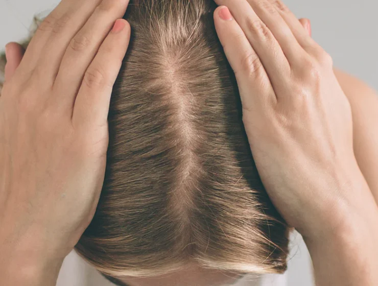 scalp exfoliation tips for hair loss