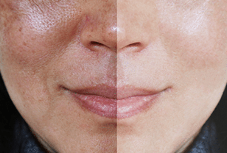 how to treat sun-damaged skin naturally