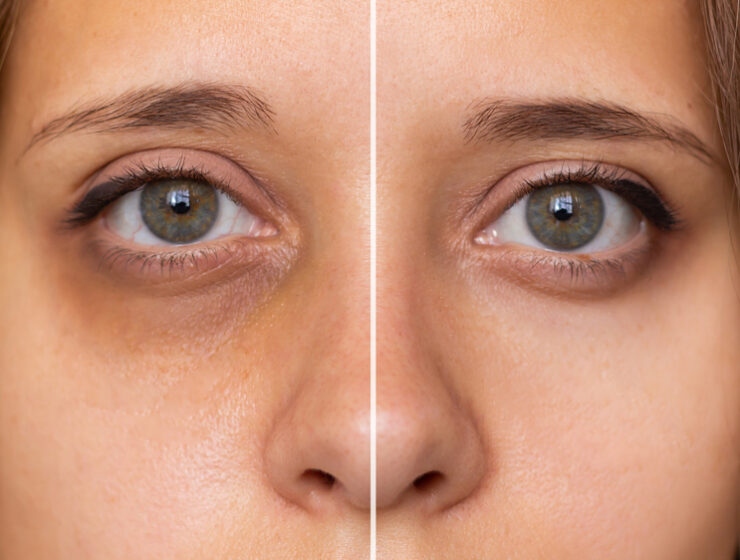 home remedies for dark circles under eyes