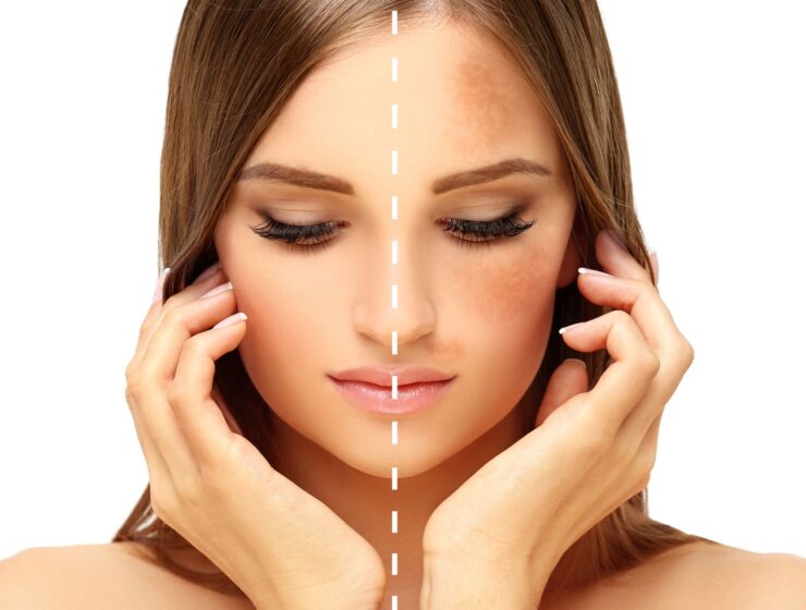 how to reduce hyperpigmentation fast
