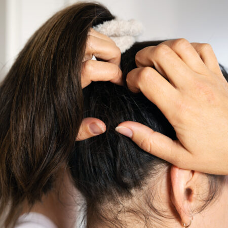 Homemade remedies for itchy scalp