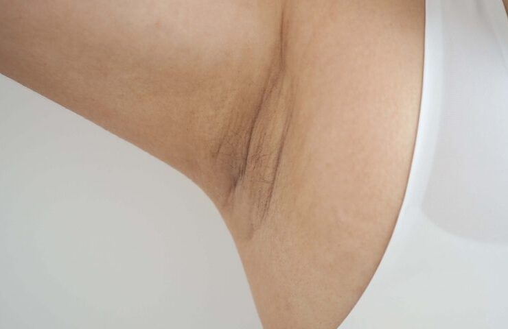 home remedies for dark underarms