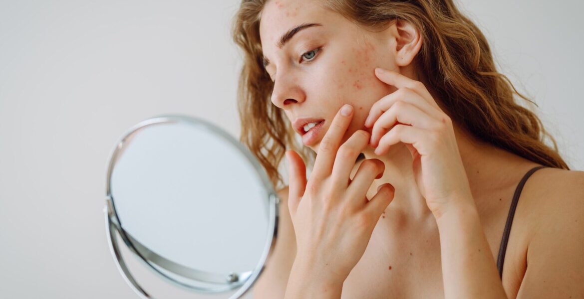 Natural ways to reduce forehead acne