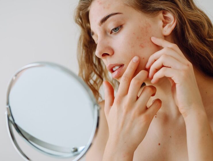 Natural ways to reduce forehead acne