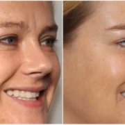 How to reduce smile lines without injections