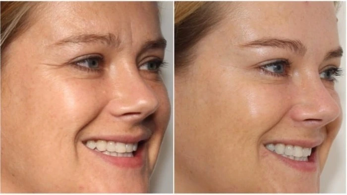 How to reduce smile lines without injections