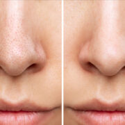 Skincare tips for reducing large pores