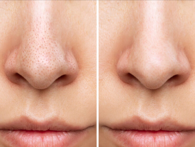 Skincare tips for reducing large pores