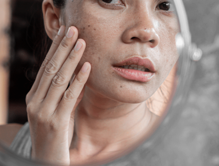 How to get rid of dull skin naturally