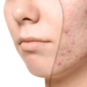 best skincare ingredients for acne scars