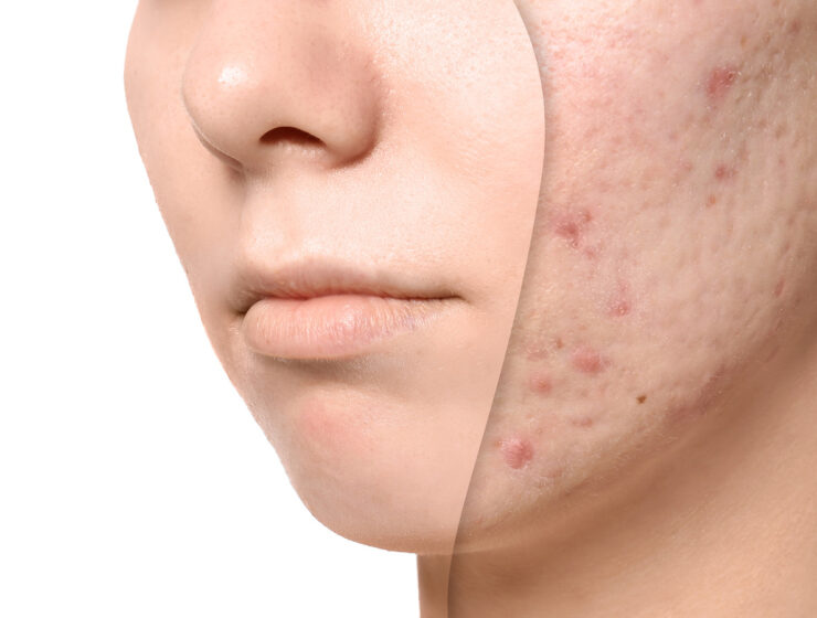 best skincare ingredients for acne scars