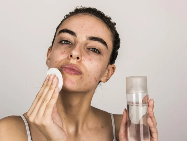 skincare routine for sensitive acne prone skin