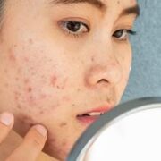 Anti-acne tips for teenage skin problems