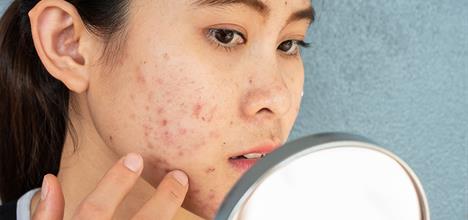 Anti-acne tips for teenage skin problems