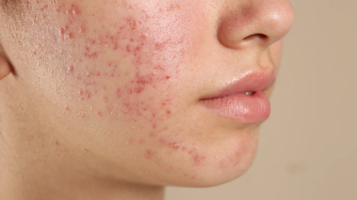 natural remedies for hormonal acne treatment