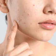 best skincare routine for acne scars and blemishes