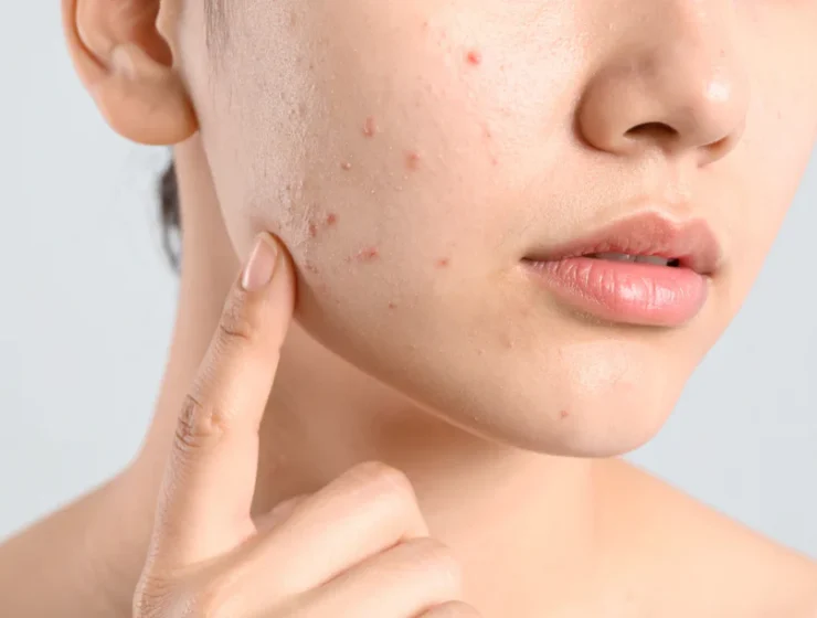 best skincare routine for acne scars and blemishes