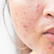 Natural remedies for acne scars at home