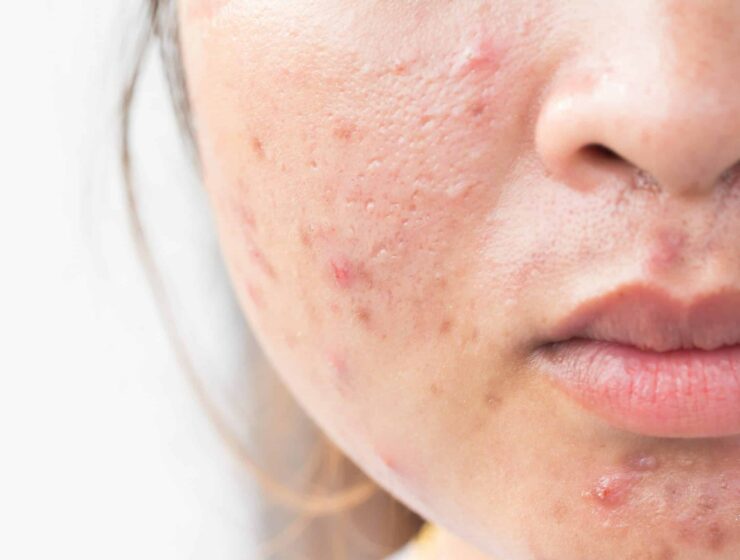 Natural remedies for acne scars at home