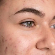 How to get rid of dark spots on face