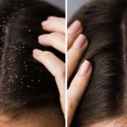 tips for maintaining healthy scalp and preventing dandruff