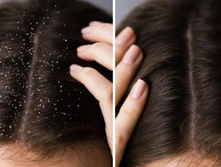 tips for maintaining healthy scalp and preventing dandruff