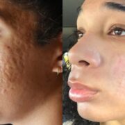 natural remedies for treating acne scars and blemishes fast