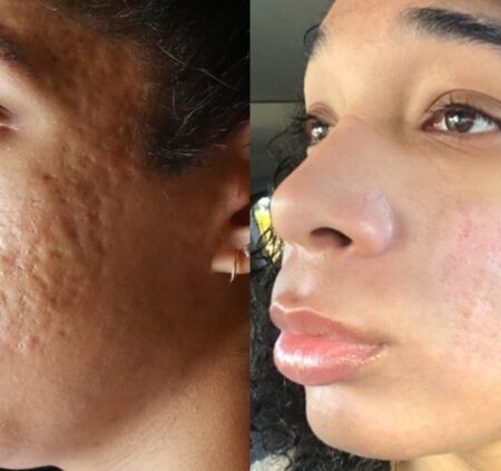 natural remedies for treating acne scars and blemishes fast