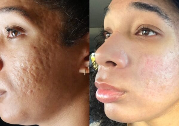 natural remedies for treating acne scars and blemishes fast