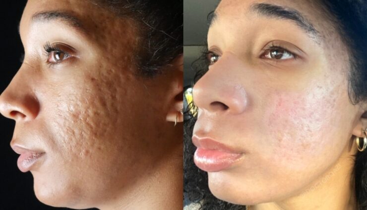 natural remedies for treating acne scars and blemishes fast