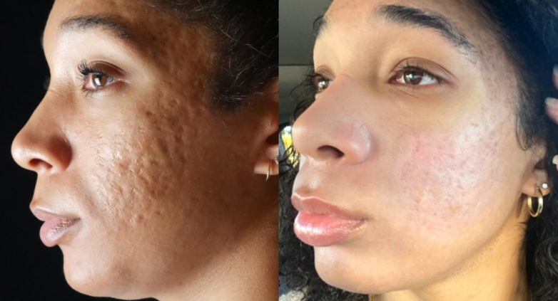 natural remedies for treating acne scars and blemishes fast